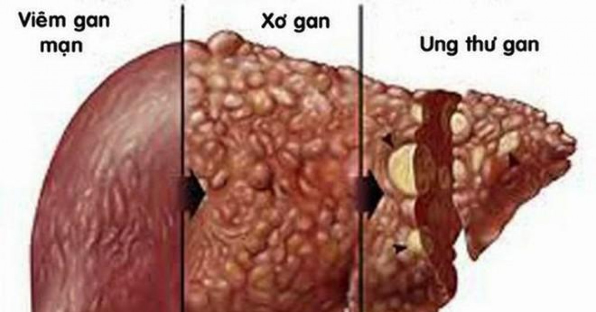 Sức khỏe đời sống - Căn bệnh khiến 30 triệu người Việt mắc, nguyên nhân không thể ngờ