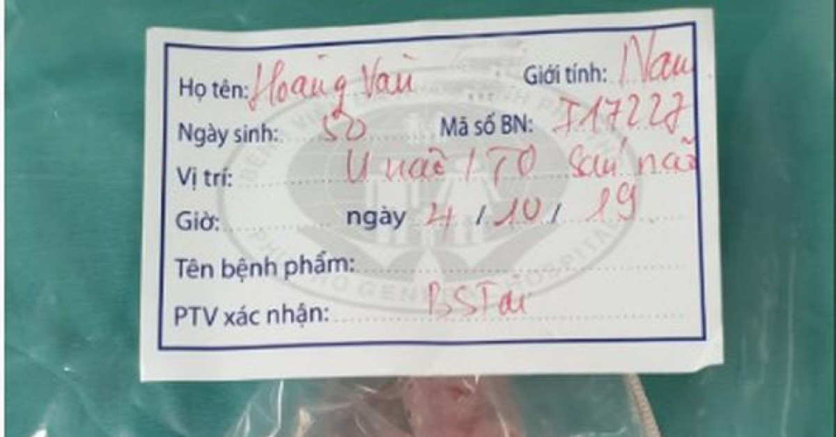 Sức khỏe đời sống - Bỗng nhiên mất trí nhớ, bác sĩ tìm ra thủ phạm là ổ sán trong não
