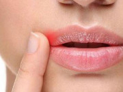 Sức khỏe đời sống - Phát hiện đột phá về virus bệnh tình dục phổ biến nhất thế giới