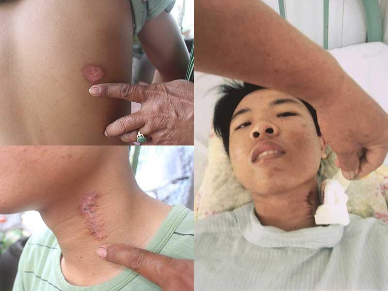 Em Hậu sau khi xuất viện về nhà, vết thương vẫn còn sẹo ở vùng lưng và cổ. Ảnh: NGỌC NGÂN. Em Hậu bị trúng đạn ở vùng lưng và cổ lúc nhập bệnh viện cấp cứu. (Ảnh do gia đình nạn nhân cung cấp)