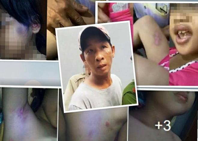 Việt và những vết thương mà đối tượng này gây ra trên người bé gái 6 tuổi.