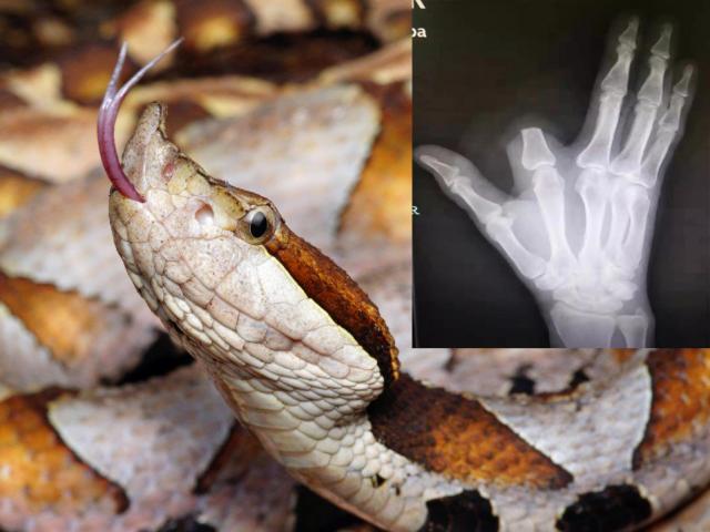 Thế giới - TQ: Tự chặt ngón tay vì "ngũ bộ xà" cắn, đi 80km tới bệnh viện và hối không kịp khi nghe kết luận