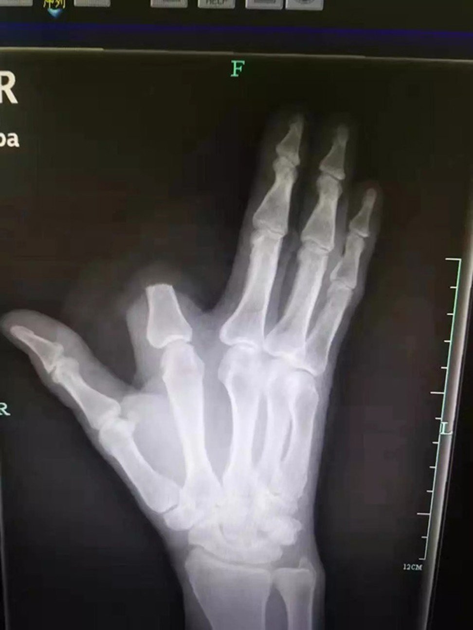 Ảnh chụp X-quang bàn tay bị chặt mất ngón trỏ của ông Zhang 
