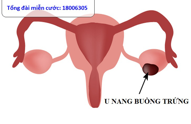Những điều bạn cần biết về bệnh u nang buồng trứng - 1