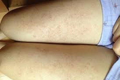 Mụn sẩn, mụn viêm do viêm nang lông ở đùi