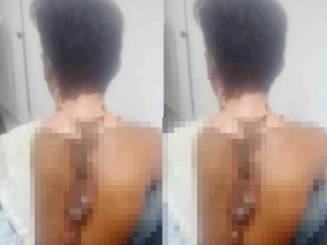 Pháp luật - Hé lộ nguyên nhân nam thanh niên bị tạt nước sôi bỏng nặng nhập viện