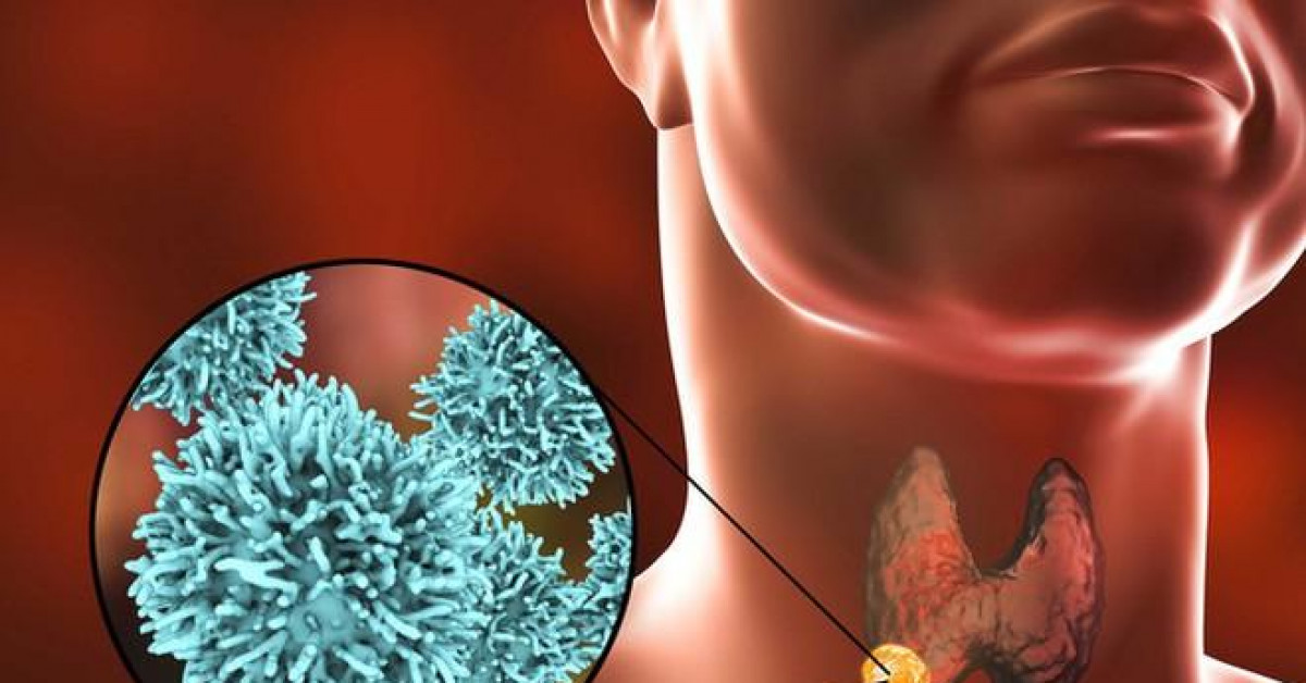 Sức khỏe đời sống - Đua nhau mổ bướu cổ: Biến người khỏe thành thương binh?