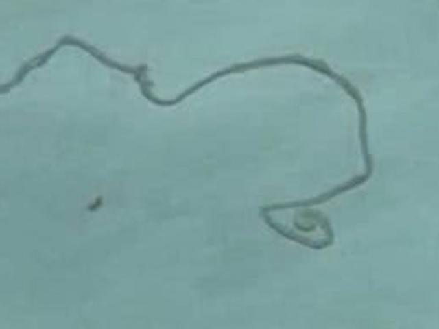 Phi thường - kỳ quặc - Thấy đau đầu, tìm ra con vật dài 12cm sống trong não suốt 15 năm