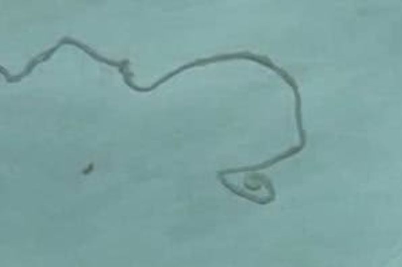 Con sán dây sống trong não bệnh nhân.