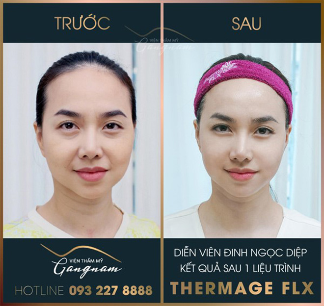 DV Đinh Ngọc Diệp sở hữu gương mặt thon gọn, mịn màng sau khi sử dụng 1 liệu trình Thermage FLX