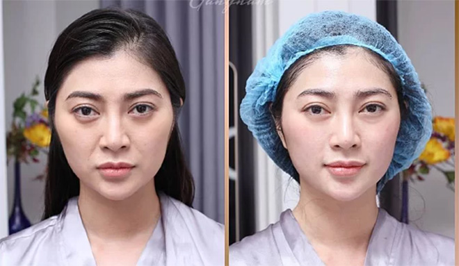 DV Thanh Trúc sau khi sử dụng 1 liệu trình Thermage FLX