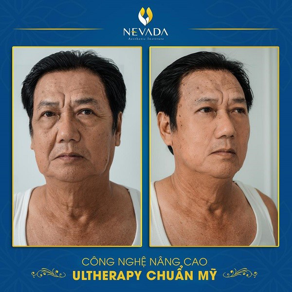 Diễn viên Mai Huỳnh trẻ hóa da bằng công nghệ Ultherapy chuẩn Mỹ