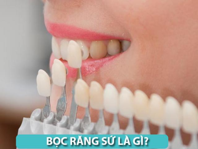 Bọc răng sứ là gì? Những tác hại và biến chứng nguy hiểm khi bọc răng sứ