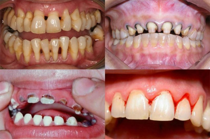 Bọc răng sứ là gì? Những tác hại và biến chứng nguy hiểm khi bọc răng sứ - 6