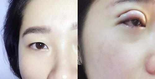 Cắt mí mắt – không đơn giản như bạn vẫn nghĩ - 2