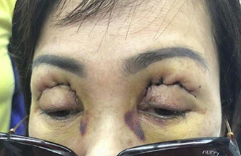 Cắt mí mắt – không đơn giản như bạn vẫn nghĩ - 1