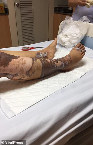 Phần da ở chân của Weerasuchart bị tổn thương sau sự cố điện giật