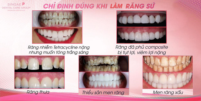 Thực hư chuyện Thanh Hằng bị ê buốt, chảy máu chân răng vì làm răng sứ thẩm mỹ? - 5