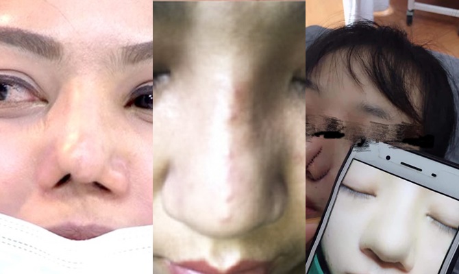 Những rủi ro khi phẫu thuật thẩm mỹ mũi, tiền mất tật mang - 1