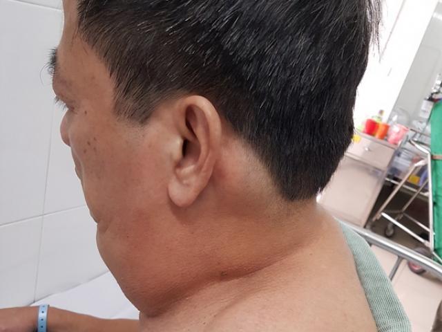 Sức khỏe đời sống - Suốt 40 năm ngày nào cũng uống 1 lít rượu, người đàn ông ở Hà Nội biến thành "dị nhân"