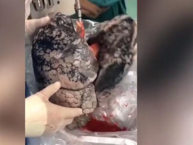Thế giới - Video: Lấy ra lá phổi của người đàn ông TQ hiến tạng, rợn người vì biểu hiện lạ