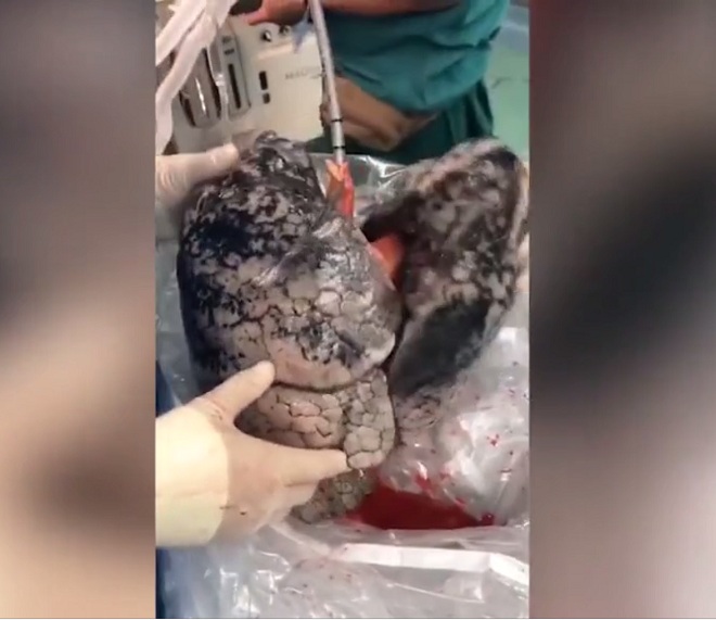 Lá phổi bị hư hại nặng này không thể sử dụng để cấy ghép được.