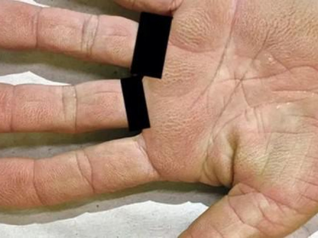 Sức khỏe đời sống - Da tay biến đổi lạ, coi chừng... ung thư phổi, dạ dày