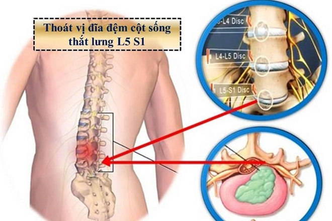 Thoát vị đĩa đệm cột sống thắt lưng: Triệu chứng, cách chữa giúp người bệnh vận động linh hoạt - 1