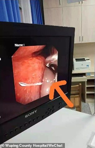 Hình ảnh nội soi cho thấy 2 con đỉa ở mũi phải và cổ họng của bệnh nhân