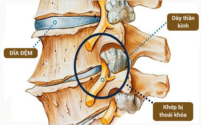 Thoái hóa cột sống thắt lưng gây ra nhiều triệu chứng sưng đau, khó vận động
