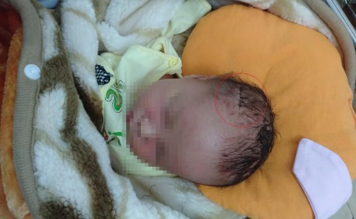 Vết rách trên đầu cháu bé được khâu lại