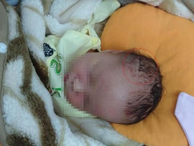 Tin tức trong ngày - Sinh mổ, bác sĩ làm rách đầu trẻ sơ sinh phải khâu 6 mũi
