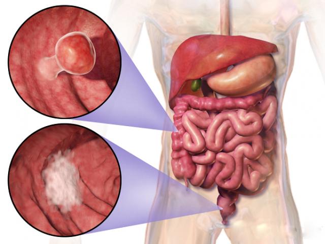 Sức khỏe đời sống - Muốn đề phòng căn bệnh &amp;quot;sát thủ&amp;quot; ung thư ruột kết, phải biết rõ những điều này