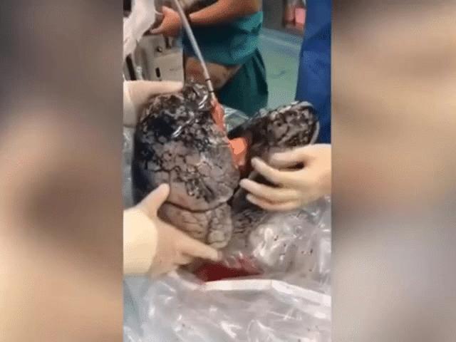 Thế giới - NÓNG nhất tuần: Điều gây kinh hãi trong lá phổi của người đàn ông TQ hiến tạng