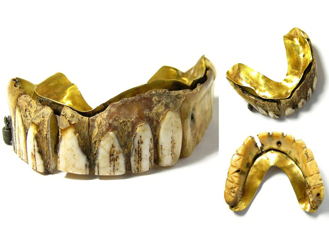 Thị trường - Tiêu dùng - Đào được bộ răng giả trên cánh đồng, "hết hồn" khi biết giá lên tới hơn 200 triệu