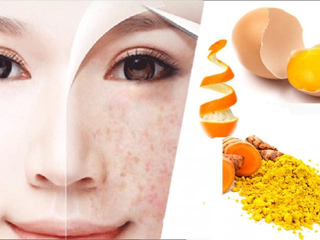 Làm đẹp - 20 Cách trị tàn nhang từ thiên nhiên an toàn hiệu quả tại nhà