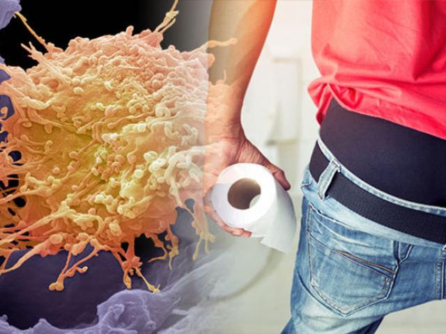 Sức khỏe đời sống - Ngoài "yêu cửa sau" là tác nhân gây ung thư hậu môn, mọi người cần biết 10 điều này