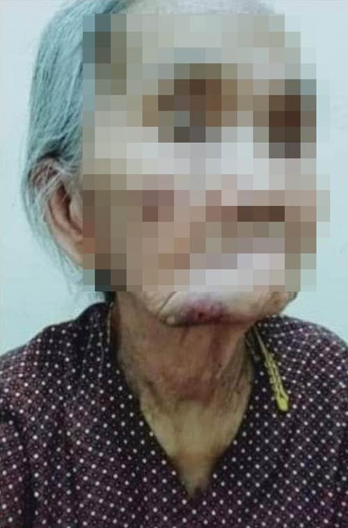 Cụ bà bầm tím mặt sau khi bị cháu đánh đập