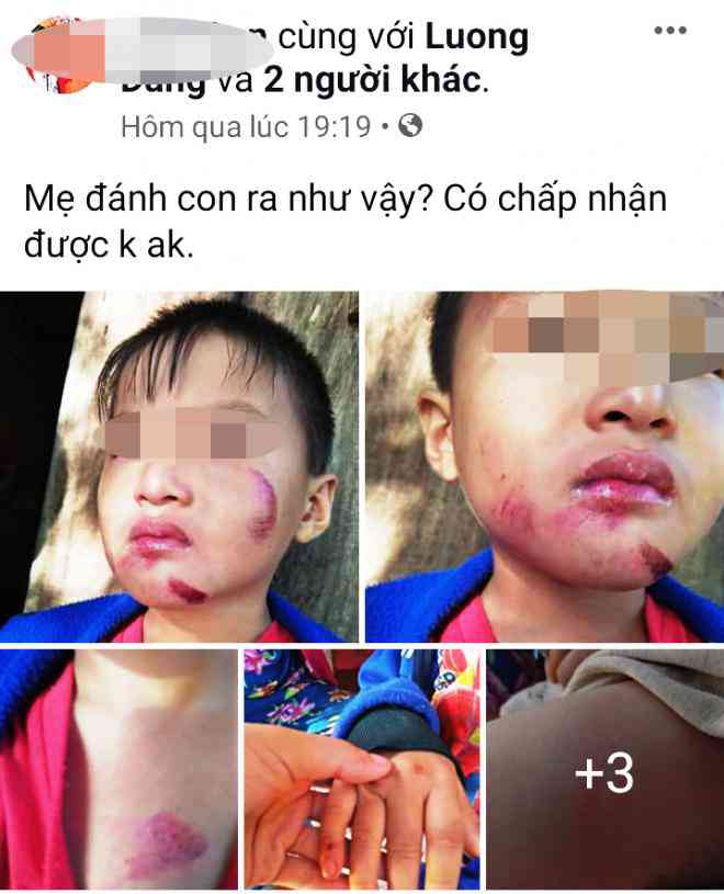 Cháu T. bị trận đòn không thương tiếc, kết quả thương tích khắp cơ thể.