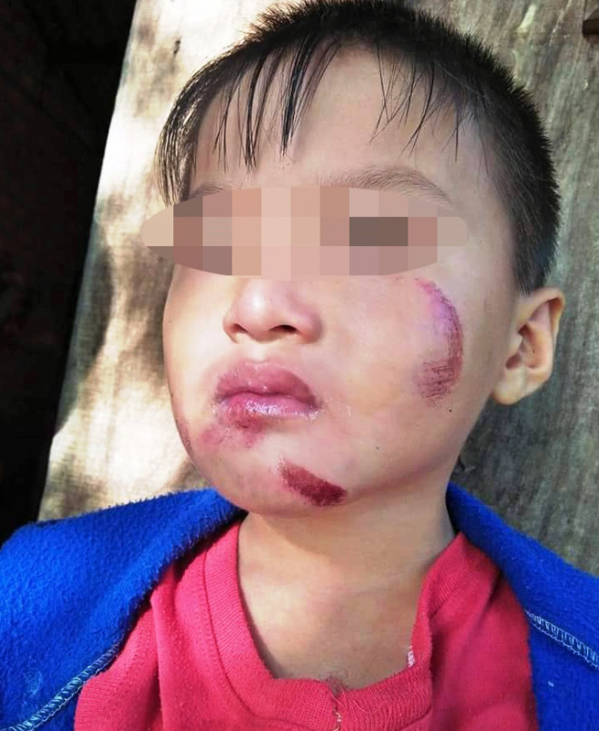 Nhiều người nhìn hình ảnh cháu T. bị thương mà không khỏi xót xa.