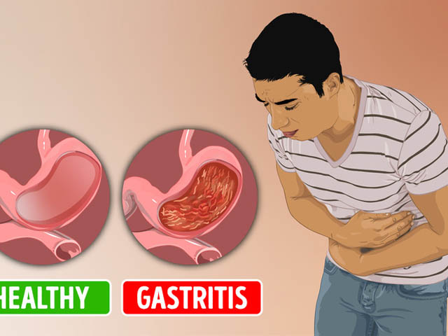 Sức khỏe đời sống - 12 triệu chứng bạn đã mắc bệnh viêm dạ dày mà không hay biết
