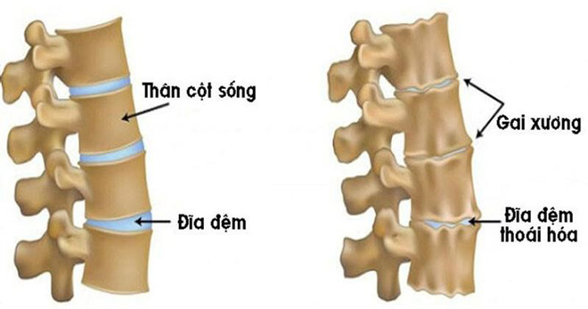 Bệnh gai cột sống lưng, cổ: Chuyên gia chỉ rõ triệu chứng, cách chữa trị hiệu quả cao - 1