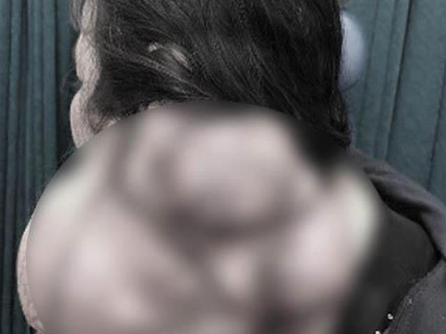 Sức khỏe đời sống - Người phụ nữ gần 50 tuổi mang “chiếc đầu thứ hai” suốt 20 năm