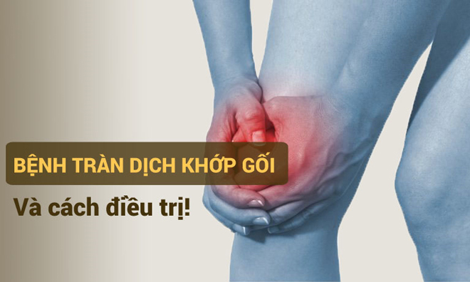 Tràn dịch khớp gối nhẹ hay nặng cũng khỏi nhờ “mẹo” chữa bệnh tư vấn bởi chuyên gia - 1