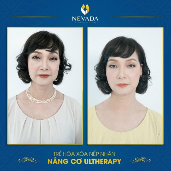 NSND Lê Khanh và kết quả trẻ hóa da bằng công nghệ Ultherapy sau 60 phút