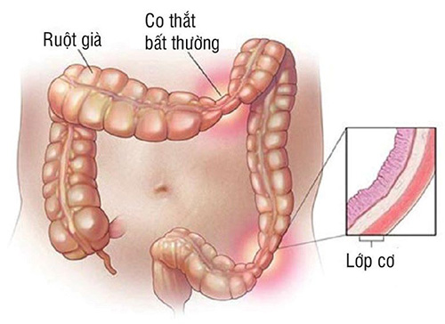 Triệu chứng viêm đại tràng co thắt