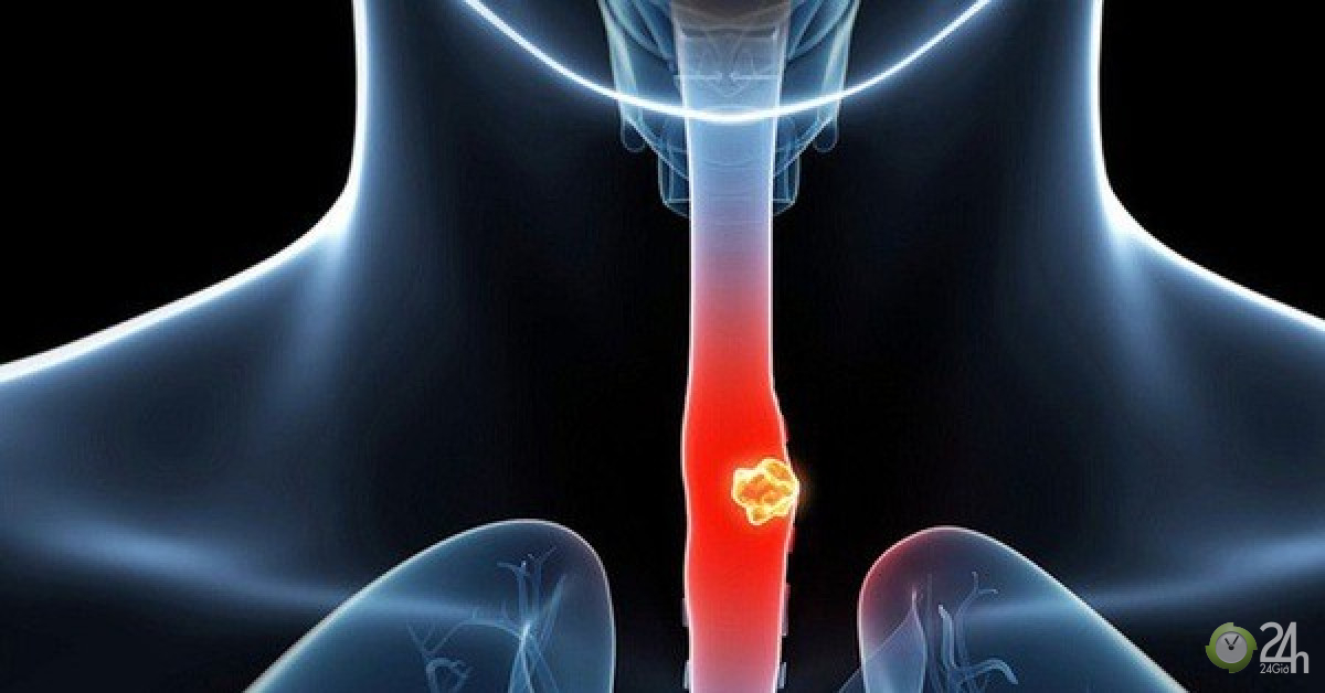 Ung thư gan: Người đàn ông mắc bệnh vì thói quen dùng cốc nhiều người dùng