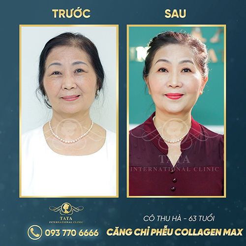 Chỉ với một liệu trình căng da bằng chỉ Collagen Max, các dấu hiệu lão hóa như vết chân chim, râu rồng chảy xệ đều biến mất.