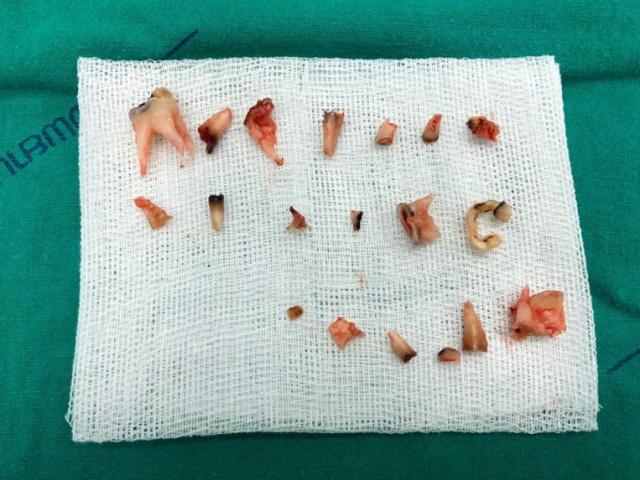 Sức khỏe đời sống - Bé 4 tuổi bị nhổ bỏ hoàn toàn 20 răng sữa vì sâu thối ăn mòn do sai lầm nghiêm trọng của bố mẹ