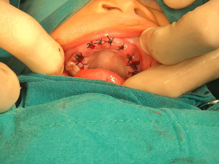 Bé 4 tuổi bị nhổ bỏ hoàn toàn 20 răng sữa vì sâu thối ăn mòn do sai lầm nghiêm trọng của bố mẹ - 4